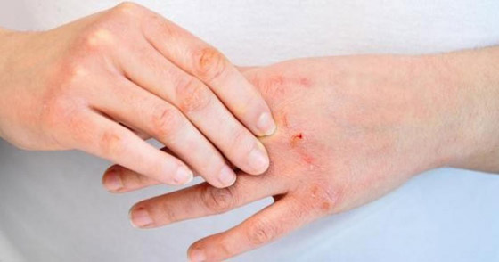 5 علامات على الجلد تشير للإصابة بأمراض القلب صورة رقم 5