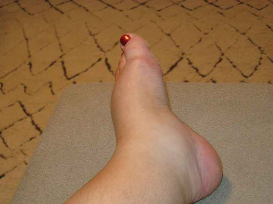 5 علامات على الجلد تشير للإصابة بأمراض القلب صورة رقم 1