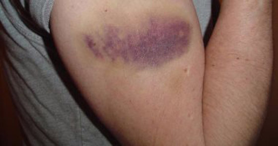 5 علامات على الجلد تشير للإصابة بأمراض القلب صورة رقم 3