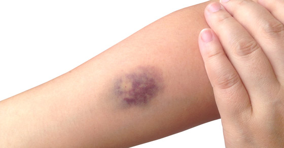 5 علامات على الجلد تشير للإصابة بأمراض القلب صورة رقم 2