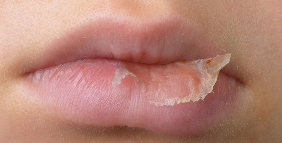 انتبهي.. هذه العادات تؤدي إلى اسمرار الشفاه صورة رقم 2