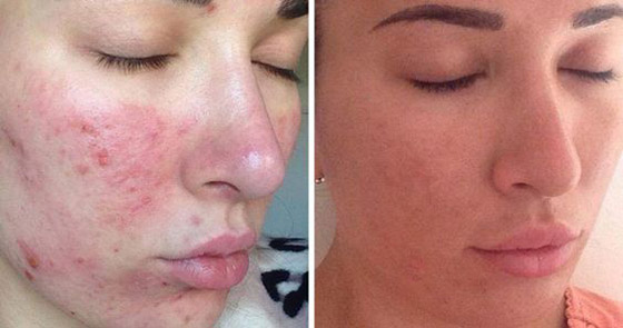 3 إجراءات للتخلص من فرط تصبغ البشرة صورة رقم 4