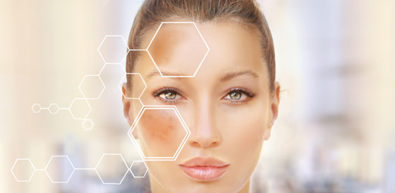 3 إجراءات للتخلص من فرط تصبغ البشرة صورة رقم 3