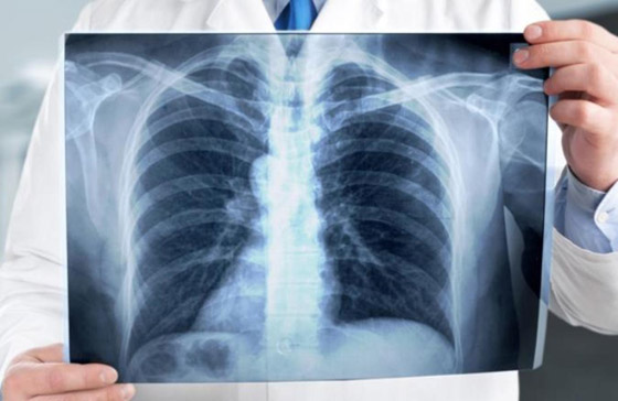 لا يقل خطرا عن كورونا.. خبراء يحذرون من إهمال 