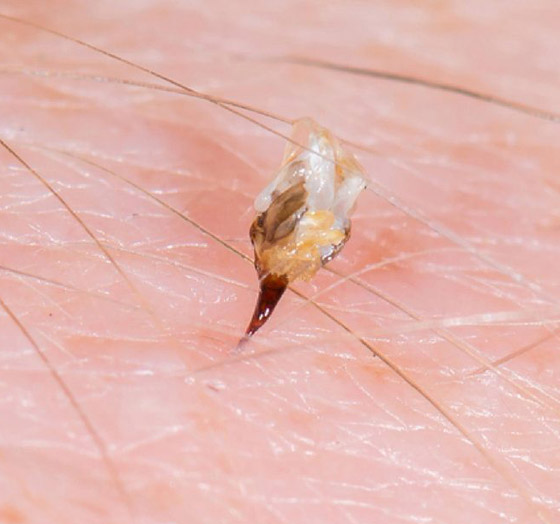 لا تتركها تتهيج وانتبه للحساسية.. علاجات طبية ومنزلية للسعات النحل صورة رقم 7 لا تتركها تتهيج وانتبه للحساسية.. علاجات طبية ومنزلية للسعات النحل صورة رقم 7