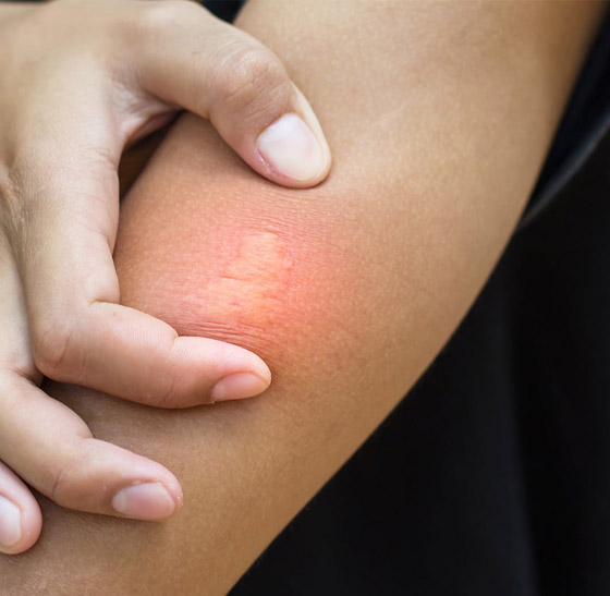 لا تتركها تتهيج وانتبه للحساسية.. علاجات طبية ومنزلية للسعات النحل صورة رقم 9 لا تتركها تتهيج وانتبه للحساسية.. علاجات طبية ومنزلية للسعات النحل صورة رقم 9