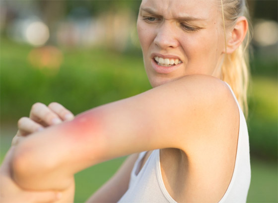 لا تتركها تتهيج وانتبه للحساسية.. علاجات طبية ومنزلية للسعات النحل صورة رقم 2 لا تتركها تتهيج وانتبه للحساسية.. علاجات طبية ومنزلية للسعات النحل صورة رقم 2