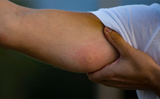 لا تتركها تتهيج وانتبه للحساسية.. علاجات طبية ومنزلية للسعات النحل صورة رقم 3 لا تتركها تتهيج وانتبه للحساسية.. علاجات طبية ومنزلية للسعات النحل صورة رقم 3