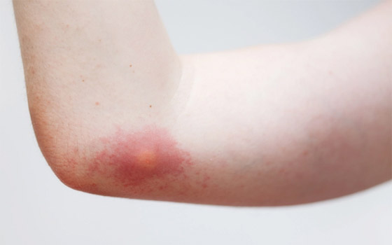 لا تتركها تتهيج وانتبه للحساسية.. علاجات طبية ومنزلية للسعات النحل صورة رقم 4 لا تتركها تتهيج وانتبه للحساسية.. علاجات طبية ومنزلية للسعات النحل صورة رقم 4