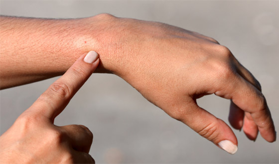 لا تتركها تتهيج وانتبه للحساسية.. علاجات طبية ومنزلية للسعات النحل صورة رقم 6 لا تتركها تتهيج وانتبه للحساسية.. علاجات طبية ومنزلية للسعات النحل صورة رقم 6