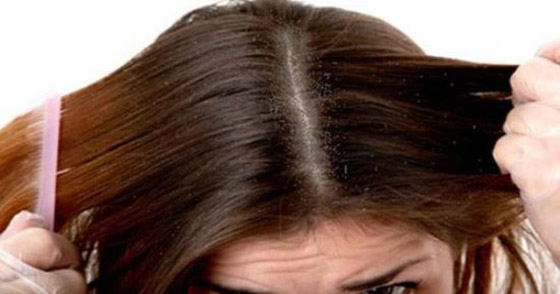 مكونات طبيعية تخلصك من قشرة الرأس صورة رقم 7