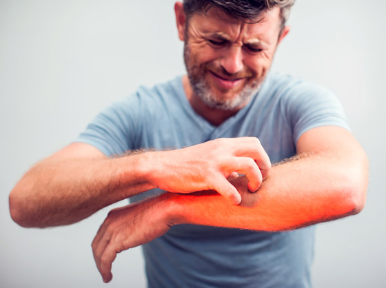 تعاني من الحكة المفاجئة أو طفح جلدي؟ هذه الأطعمة قد تكون السبب..! صورة رقم 5 تعاني من الحكة المفاجئة أو طفح جلدي؟ هذه الأطعمة قد تكون السبب..! صورة رقم 5