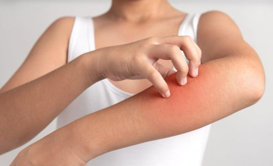 تعاني من الحكة المفاجئة أو طفح جلدي؟ هذه الأطعمة قد تكون السبب..! صورة رقم 8 تعاني من الحكة المفاجئة أو طفح جلدي؟ هذه الأطعمة قد تكون السبب..! صورة رقم 8