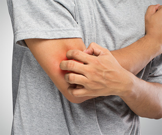 تعاني من الحكة المفاجئة أو طفح جلدي؟ هذه الأطعمة قد تكون السبب..! صورة رقم 9 تعاني من الحكة المفاجئة أو طفح جلدي؟ هذه الأطعمة قد تكون السبب..! صورة رقم 9