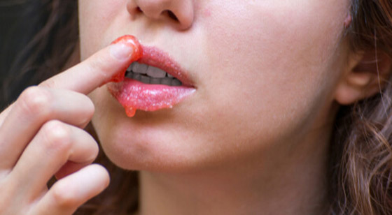 6 خلطات طبيعية لترطيب الشفاه صورة رقم 6