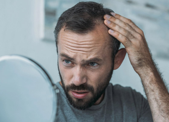 مظهرها يزعجك وتسبب لك الإحراج؟ 8 علاجات طبيعية لفراغات الشعر صورة رقم 3