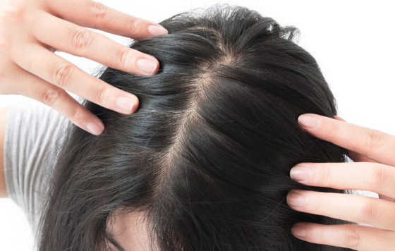 مظهرها يزعجك وتسبب لك الإحراج؟ 8 علاجات طبيعية لفراغات الشعر صورة رقم 5