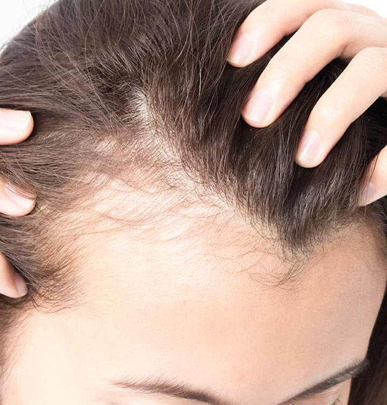 مظهرها يزعجك وتسبب لك الإحراج؟ 8 علاجات طبيعية لفراغات الشعر صورة رقم 6