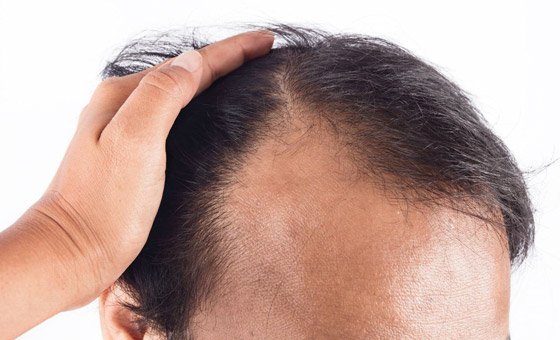 مظهرها يزعجك وتسبب لك الإحراج؟ 8 علاجات طبيعية لفراغات الشعر صورة رقم 8