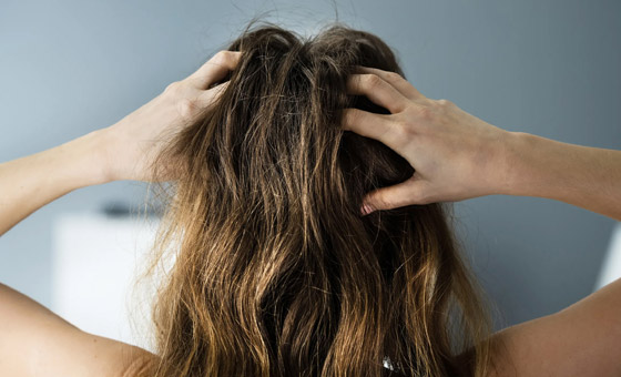 تسبب لك الإحراج؟ إليك 8 علاجات منزلية للتخفيف من حكة الرأس وجفافه صورة رقم 11