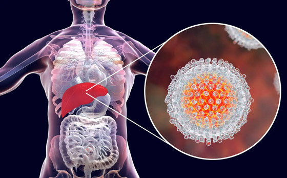 التهاب الكبد الغامض يواصل انتشاره! إصابات جديدة بكندا وآسيا تثير القلق صورة رقم 2 التهاب الكبد الغامض يواصل انتشاره! إصابات جديدة بكندا وآسيا تثير القلق صورة رقم 2