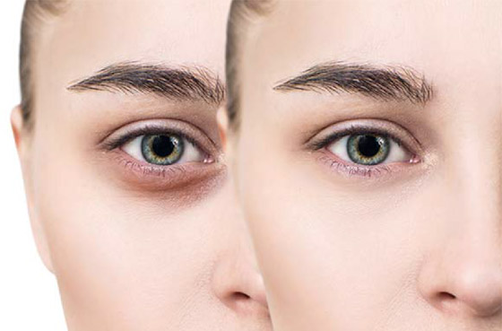 لمن يعاني من الهالات الداكنة.. هذه 9 حلول سحرية مدهشة! صورة رقم 3