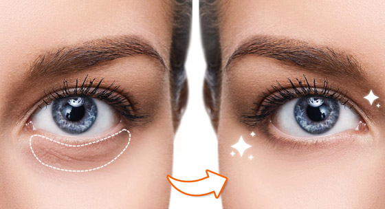 لمن يعاني من الهالات الداكنة.. هذه 9 حلول سحرية مدهشة! صورة رقم 1