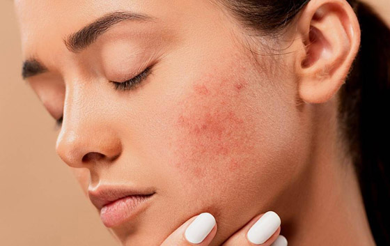 أقوى من المراهم والأدوية.. كيف تتخلص أحماض أوميغا 3 من حب الشباب؟ صورة رقم 2 أقوى من المراهم والأدوية.. كيف تتخلص أحماض أوميغا 3 من حب الشباب؟ صورة رقم 2