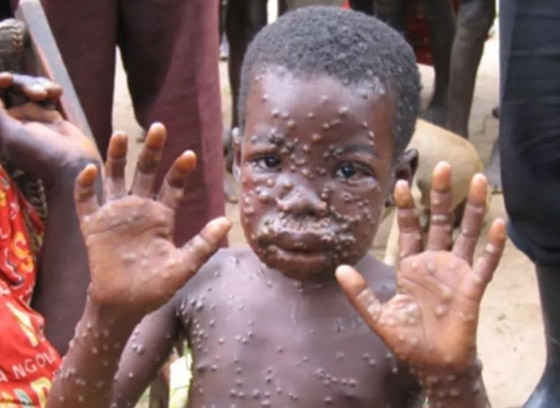 كيف يبدو جدري القردة؟ 6 رسومات تكشف تغييرات الجلد يجب الانتباه إليها صورة رقم 7