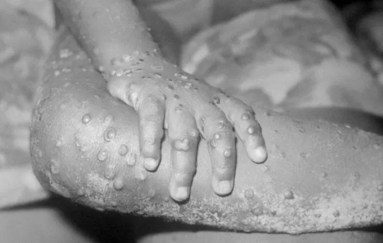 كيف يبدو جدري القردة؟ 6 رسومات تكشف تغييرات الجلد يجب الانتباه إليها صورة رقم 9