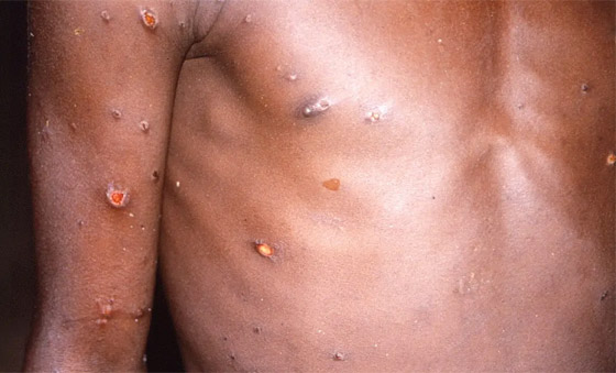 كيف يبدو جدري القردة؟ 6 رسومات تكشف تغييرات الجلد يجب الانتباه إليها صورة رقم 3