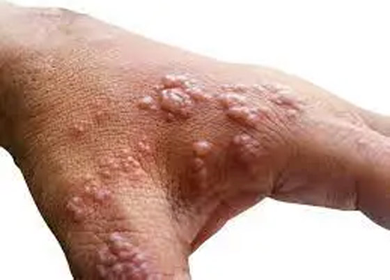 كيف يبدو جدري القردة؟ 6 رسومات تكشف تغييرات الجلد يجب الانتباه إليها صورة رقم 6