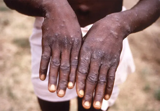 كيف يبدو جدري القردة؟ 6 رسومات تكشف تغييرات الجلد يجب الانتباه إليها صورة رقم 2