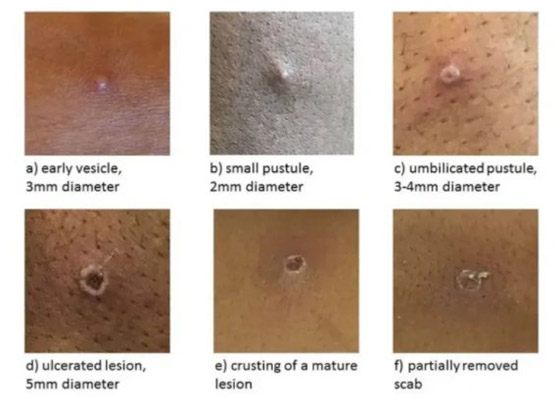 كيف يبدو جدري القردة؟ 6 رسومات تكشف تغييرات الجلد يجب الانتباه إليها صورة رقم 1