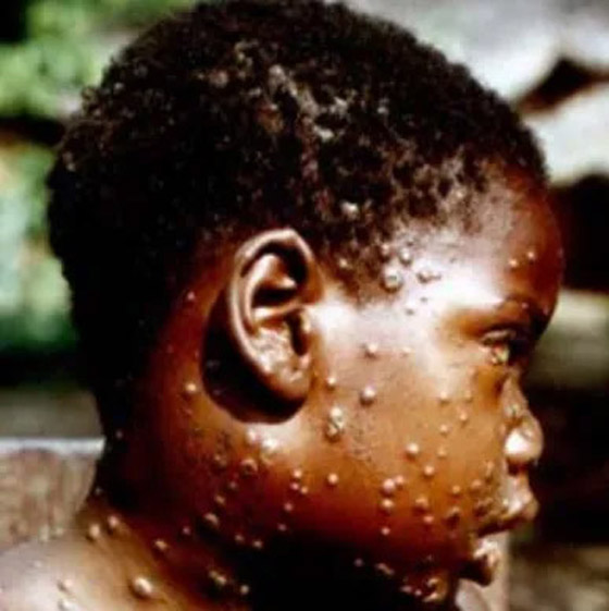 كيف يبدو جدري القردة؟ 6 رسومات تكشف تغييرات الجلد يجب الانتباه إليها صورة رقم 4