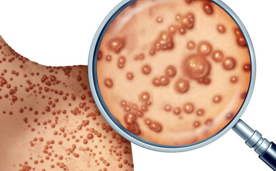 كيف يبدو جدري القردة؟ 6 رسومات تكشف تغييرات الجلد يجب الانتباه إليها صورة رقم 5