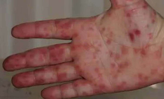 ما آخرة هذه الفيروسات؟ 11 معلومة عن إنفلونزا الطماطم بعد ظهوره في الهند! صورة رقم 2