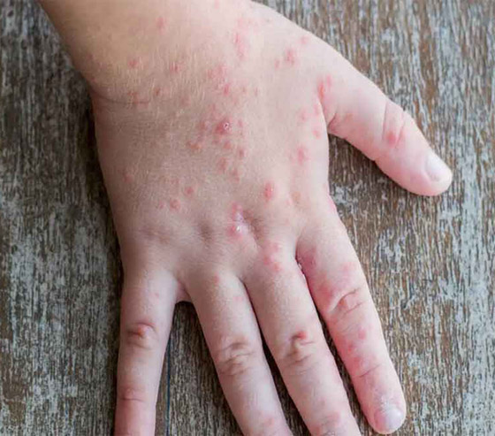 ما آخرة هذه الفيروسات؟ 11 معلومة عن إنفلونزا الطماطم بعد ظهوره في الهند! صورة رقم 5