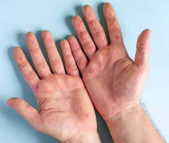 ما آخرة هذه الفيروسات؟ 11 معلومة عن إنفلونزا الطماطم بعد ظهوره في الهند! صورة رقم 8