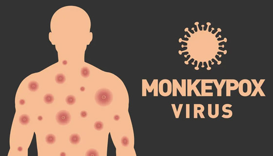 6 نصائح بسيطة.. هكذا تحمي نفسك من جدري القردة صورة رقم 1