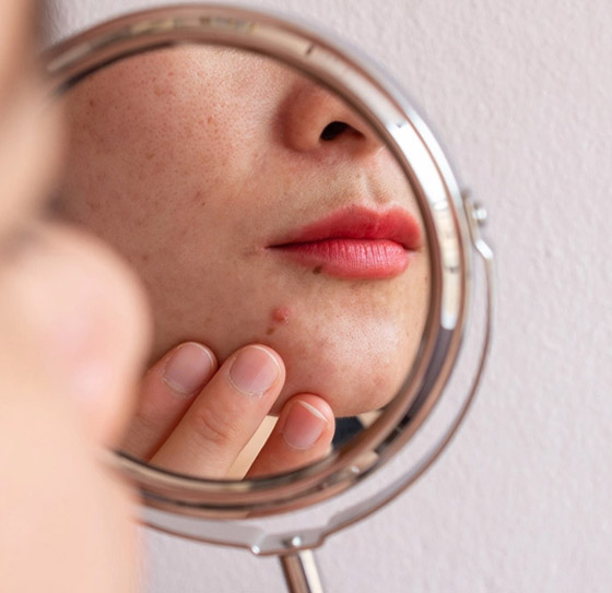 ليس بالمراهقة فقط.. أسباب ظهور حب الشباب عند البالغين وطرق السيطرة عليه صورة رقم 3 ليس بالمراهقة فقط.. أسباب ظهور حب الشباب عند البالغين وطرق السيطرة عليه صورة رقم 3