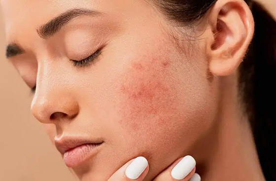 ليس بالمراهقة فقط.. أسباب ظهور حب الشباب عند البالغين وطرق السيطرة عليه صورة رقم 5 ليس بالمراهقة فقط.. أسباب ظهور حب الشباب عند البالغين وطرق السيطرة عليه صورة رقم 5