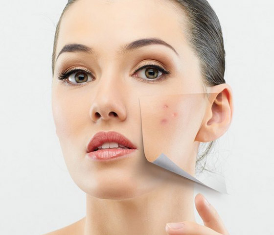 ليس بالمراهقة فقط.. أسباب ظهور حب الشباب عند البالغين وطرق السيطرة عليه صورة رقم 7 ليس بالمراهقة فقط.. أسباب ظهور حب الشباب عند البالغين وطرق السيطرة عليه صورة رقم 7