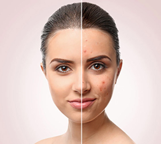 ليس بالمراهقة فقط.. أسباب ظهور حب الشباب عند البالغين وطرق السيطرة عليه صورة رقم 8 ليس بالمراهقة فقط.. أسباب ظهور حب الشباب عند البالغين وطرق السيطرة عليه صورة رقم 8