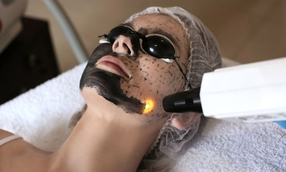 التقشير بالكربون.. مفتاح نقاء وشباب البشرة صورة رقم 2