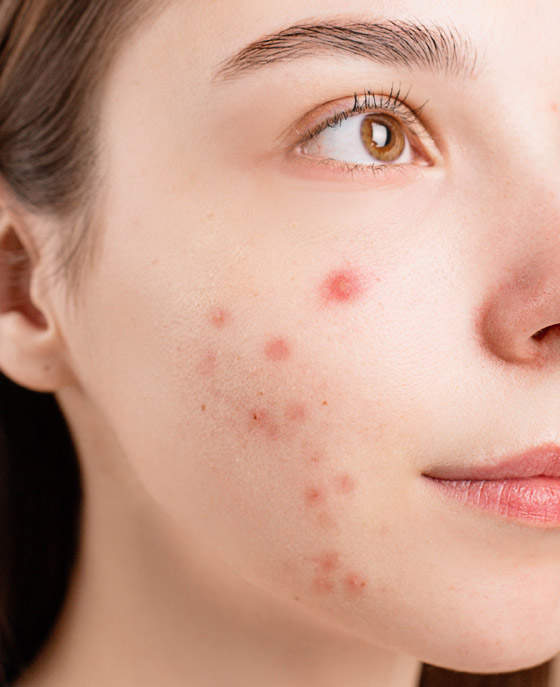 البثور الشائعة تصيب الكثيرين.. 6 أنواع والحل مختلف لكل منها صورة رقم 2 البثور الشائعة تصيب الكثيرين.. 6 أنواع والحل مختلف لكل منها صورة رقم 2