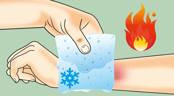 المعجون والثلج.. أخطاء شائعة عند الإصابة بالحروق تزيد الخطر صورة رقم 3 المعجون والثلج.. أخطاء شائعة عند الإصابة بالحروق تزيد الخطر صورة رقم 3