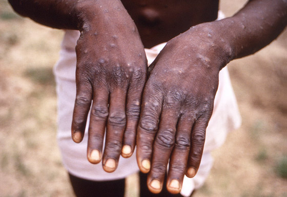 وسط تزايد إصابات جدري القرود.. قرار مرتقب للصحة العالمية صورة رقم 5 وسط تزايد إصابات جدري القرود.. قرار مرتقب للصحة العالمية صورة رقم 5