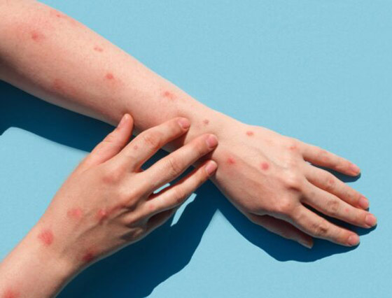 وسط تزايد إصابات جدري القرود.. قرار مرتقب للصحة العالمية صورة رقم 6 وسط تزايد إصابات جدري القرود.. قرار مرتقب للصحة العالمية صورة رقم 6