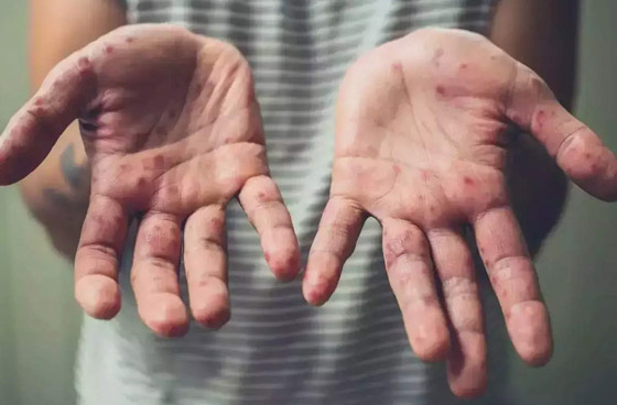 وسط تزايد إصابات جدري القرود.. قرار مرتقب للصحة العالمية صورة رقم 7 وسط تزايد إصابات جدري القرود.. قرار مرتقب للصحة العالمية صورة رقم 7